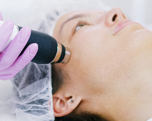 Microneedling